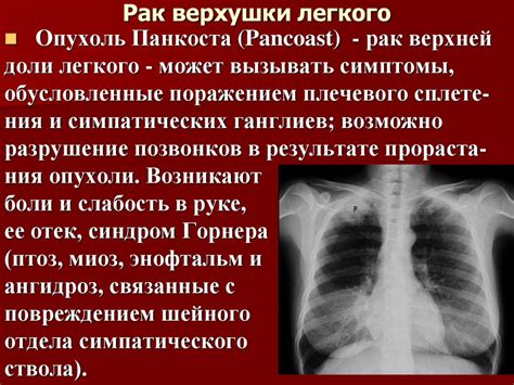 Рак легкого - презентация онлайн