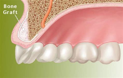 Bone Grafting in Alanya - Bone Reinforcement - Alanya Clinic