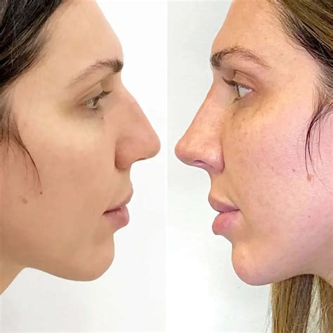 NoseFix: Filler | BeautyFix MedSpa - (212) 366-4787