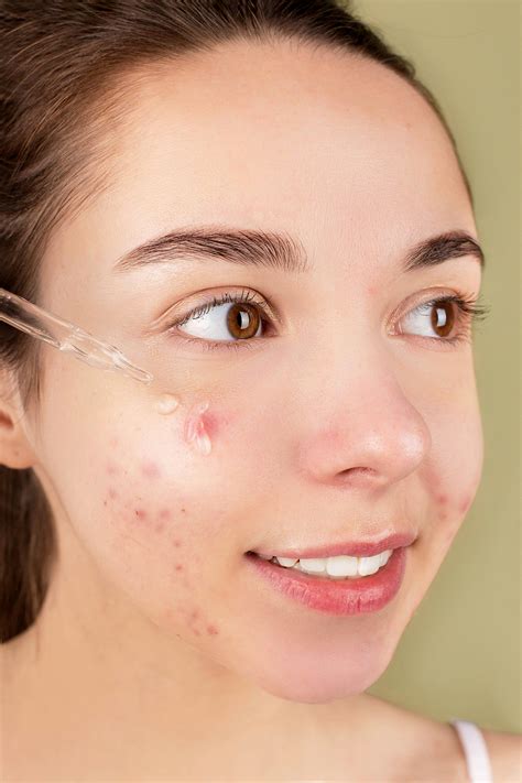 Pimple Photos, Download The BEST Free Pimple Stock Photos & HD Images