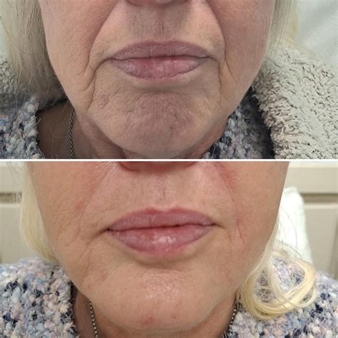 8 Point Face Lift — Select Aesthetics Clinic | Medical Aesthetics ...