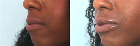 Lip Enhancement Photos | Houston, Tx | Patient 10093