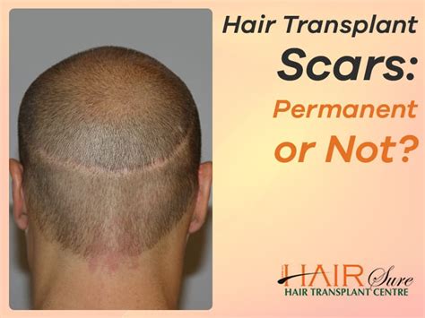 hair transplant scar healing time - Karleen Baumann