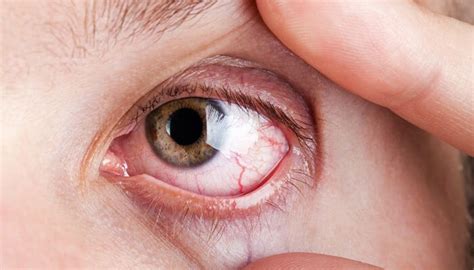 Treatments | Eye Care | Mattawan Family Eye Care