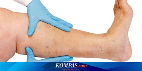 penyakit varises gejala penyebab pengobatan kompascom
