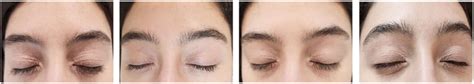 The eyelid dermatitis of this young woman responded beautifully to the ...