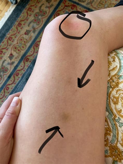 spongiotic dermatitis and lupus 2