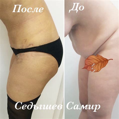 Диастаз Операция До И После - HD фотoграфии