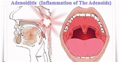 Adenoiditis - Symptoms, Causes, Diagnosis and Treatment