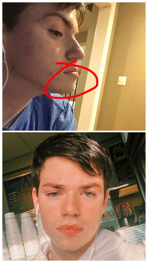How severe is my underbite and is it noticeable from the front? I hate ...