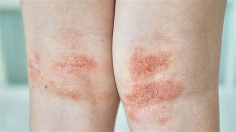 Psoriasis inversa: Schuppenflechte in Hautfalten | ZAVA