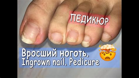 Педикюр пошагово. ВРОСШИЙ НОГОТЬ. НЕ ДЛЯ СЛАБОНЕРВНЫХ. Как стричь ногти ...