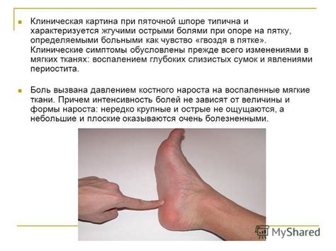Презентация на тему: "Пяточная шпора костное разрастание в виде шипа ...