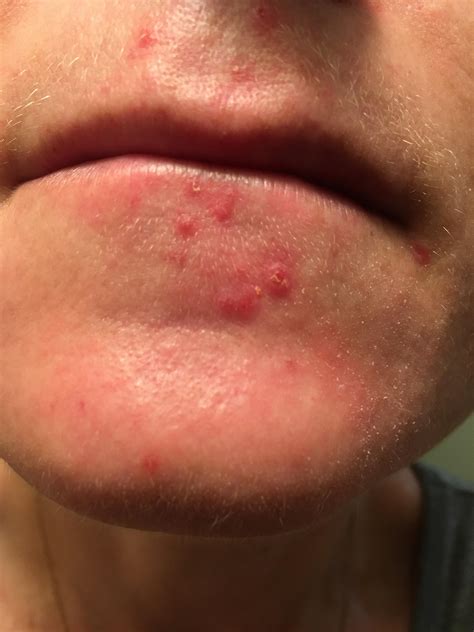 Corner Of The Mouth Acne at Jesus Ly blog