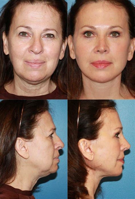 Facelift Surgery & Mini Petit Facelift San Diego Before and After ...