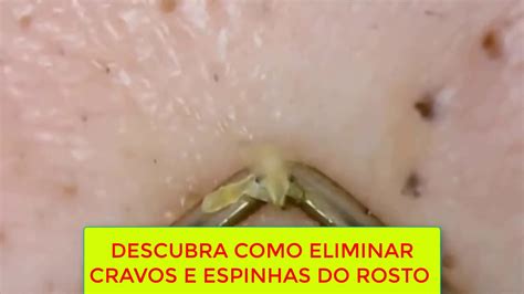 Como Tirar Espinha Do Rosto - Como Tirar Manchas de Espinha do Rosto?Como Tirar Espinhas do Rosto ...