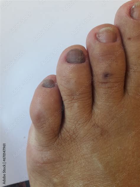 Unhas Escuras Do Pé - Unha do pé de pessoa com hipotireoidismo calosidades, micose, pele seca ...