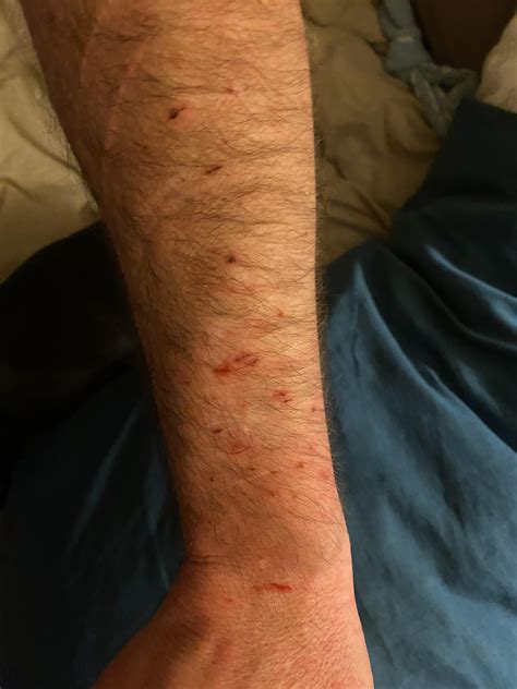 Doberman Bite Marks Boy Bitten By Doberman At Edgeworth 2NURFM