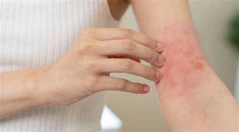 Rashes On Hands