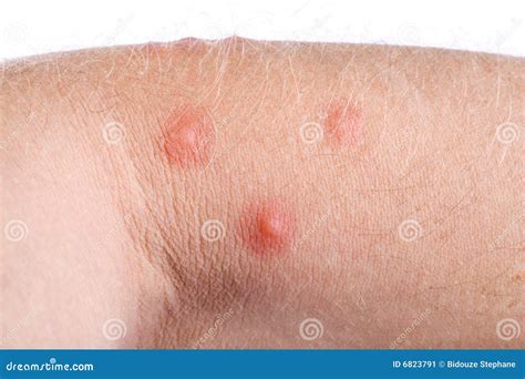 Boutons Sur La Peau Image stock - Image: 6823791