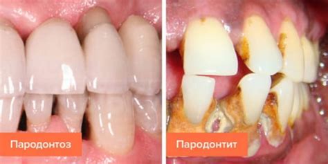 Пародонтоз | Хорошая Стоматология