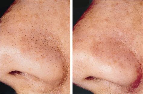 Unbelievable Blackhead Removal 2024: Before and After Pictures (Real People!) - sjhoep7