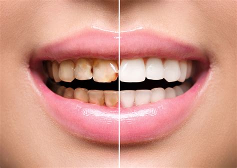 long  dental veneers typically
