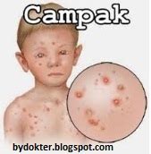 campak bydokter solusi penyakit