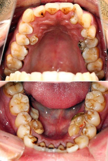 Hyperdontia (Extra Teeth) Causes, Treatment and Removal - Headgear Braces