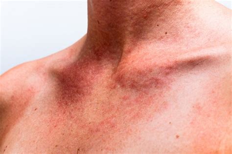 Síntomas de alergia al sol, tratamiento y cómo protegerse - Tua Saúde