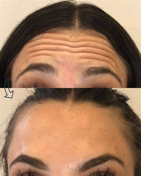 Tips to avoid frozen face Botox treatments — Park Medical Aesthetics on ...