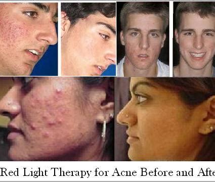 Red Light Therapy Before And After Pictures - All You Need Infos