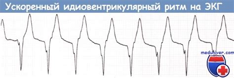 ЭКГ при ускоренном идиовентрикулярном ритме