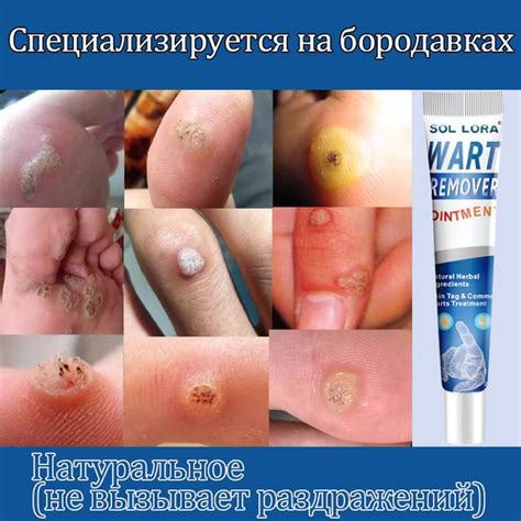 Средство от папиллом и бородавок, для удаления бородавок папиллом ...