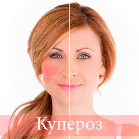 Купероз. Причины и лечение заболевания