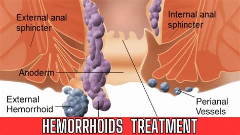 hemorrhoidsdifferent types  hemorrhoids internal  external