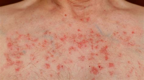 symptoms  leukemia   treatment  leukemia