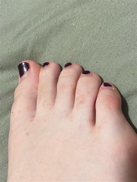 Small raised bumps on my toes? : r/medical_advice