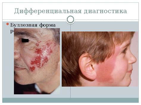 Вирусные инфекции кожи и слизистых оболочек - презентация, доклад ...