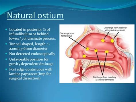 sinus ostium anatomy - Google Search | Sinusitis, Dissection, Anatomy