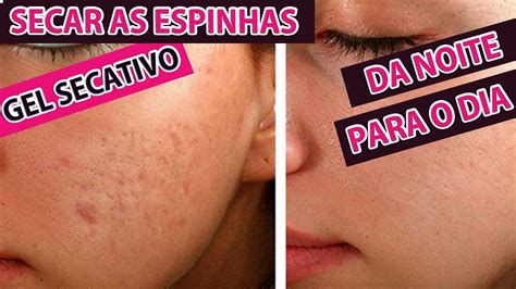 Como Secar Espinhas Em Um Dia