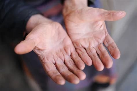 Cracked hands Stock Photos, Royalty Free Cracked hands Images ...