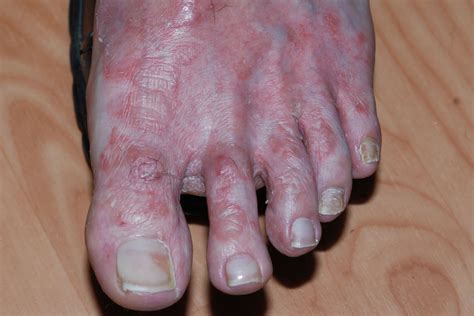 Candida Parapsilosis Nail Infection - Nail Ftempo