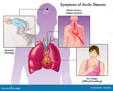 Symptoms of Aortic Stenosis Stock Vector - Illustration of fatigue ...