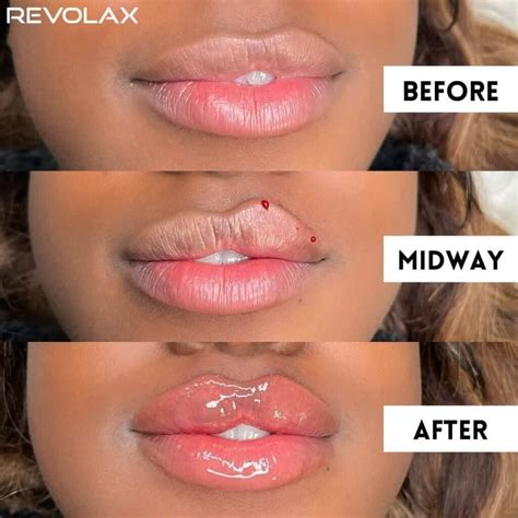 lip filler qualification  sophie peters blog