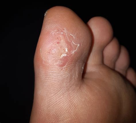 Wart cluster on big toe after 1 week of salicylic acid + nail clippers