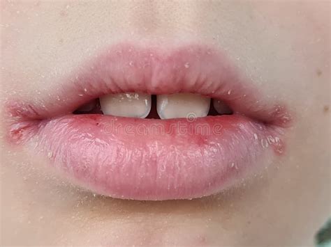 Sore on Lip of Child and Peeling of Skin Stock Image - Image of face ...