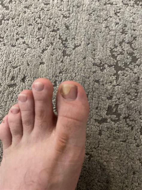 toenail    rdermatologyquestions
