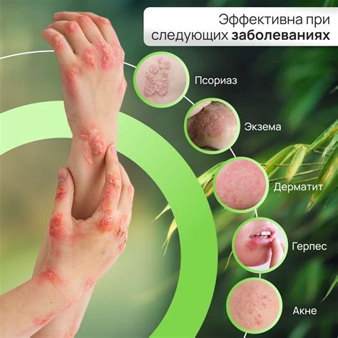 Мазь крем от псориаза, экземы, атопического дерматита, Китайская чудо ...