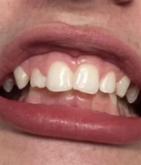 What kind of bite is this? : r/Teeth